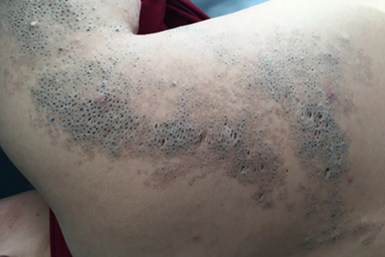 黑头粉刺痣背部黑斑图 黑头粉刺痣背部黑斑图