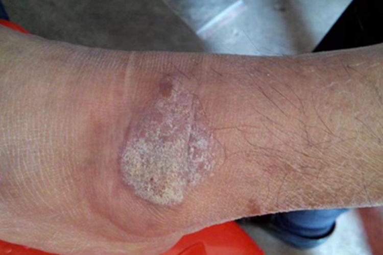 慢性湿疹脚踝红肿图