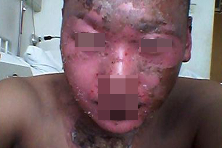 深Ⅱ度烧伤面部脱皮图