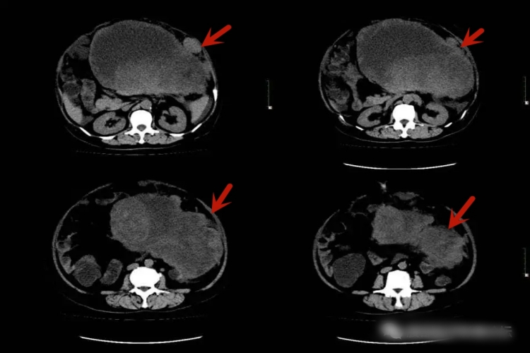 胰腺平滑肌肉瘤影像图 胰腺平滑肌肉瘤影像图