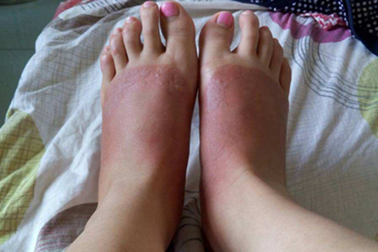 Ⅲ度冻伤脚背症状图