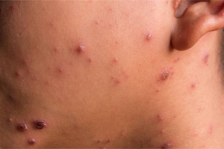 三期梅毒面部图