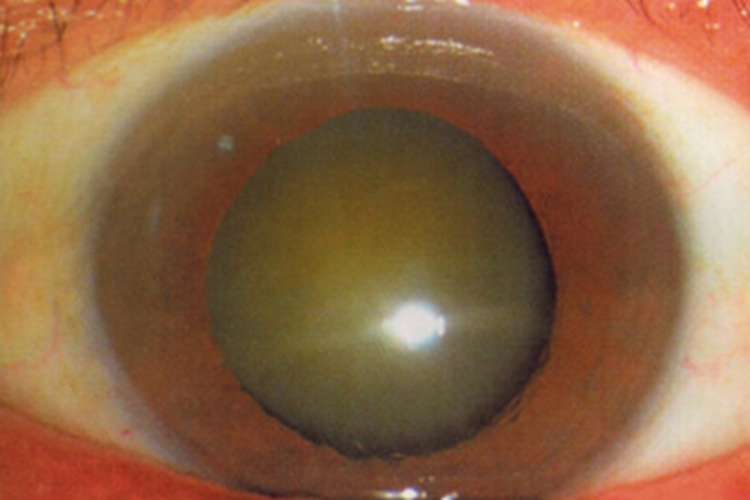 年龄相关性白内障症状图