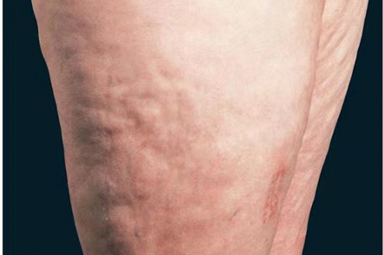 嗜酸性筋膜炎大腿症状图 嗜酸性筋膜炎大腿症状图