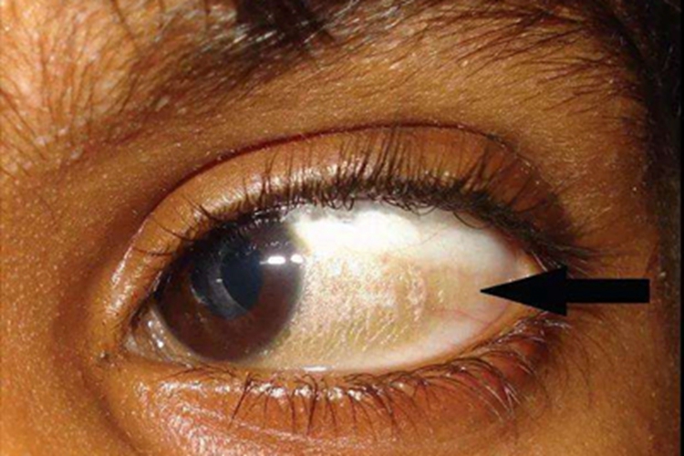 角膜软化症结膜黄斑图