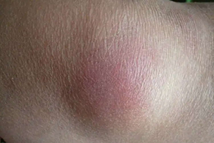 硬红斑腿上红色大包图