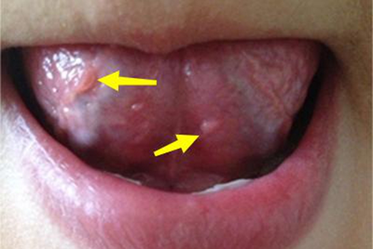 女性尖锐湿疣舌头肉粒图 女性尖锐湿疣舌头肉粒图