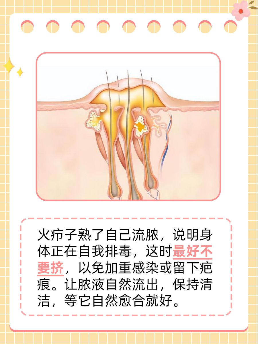 火疖子熟了自己流脓还手动挤吗?看完你就懂!