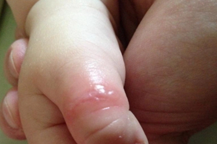 蠓虫叮咬引起的皮肤反应小水疱图