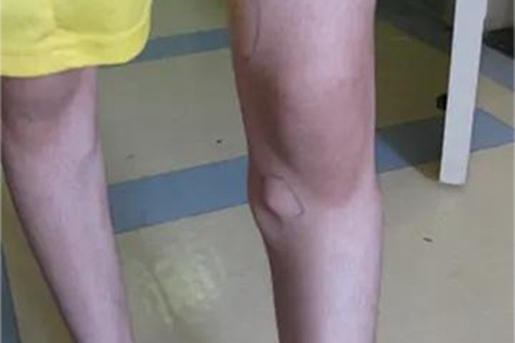 多发性骨软骨瘤腿上长小疙瘩图