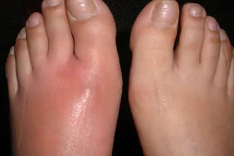 丹毒样皮炎图 丹毒样皮炎图