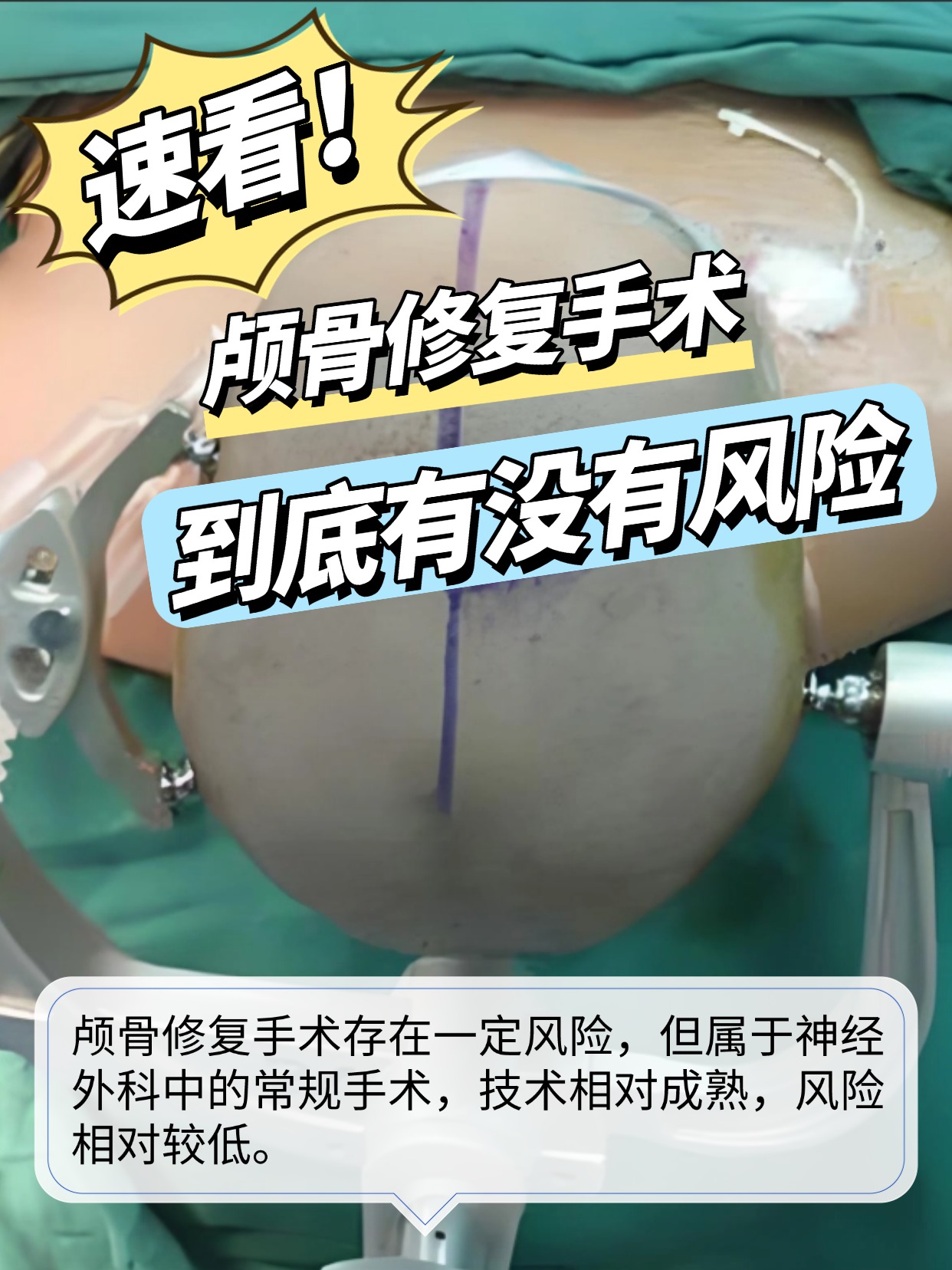 速看!颅骨修复手术到底有没有风险