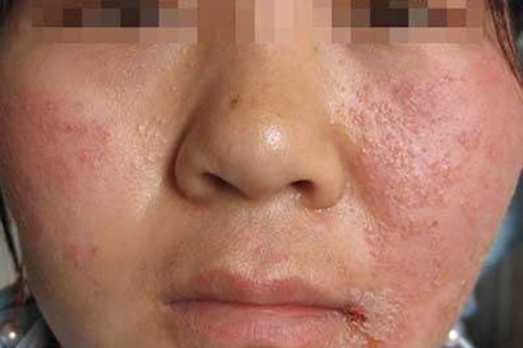 慢性接触性皮炎面部小疙瘩图