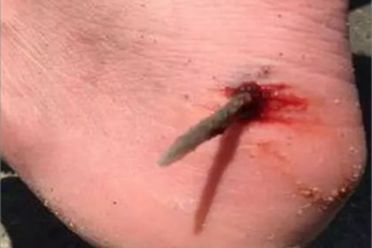 戳伤脚部结血痂出血图 戳伤脚部结血痂出血图