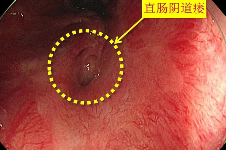 女婴阴道直肠瘘图 女婴阴道直肠瘘图