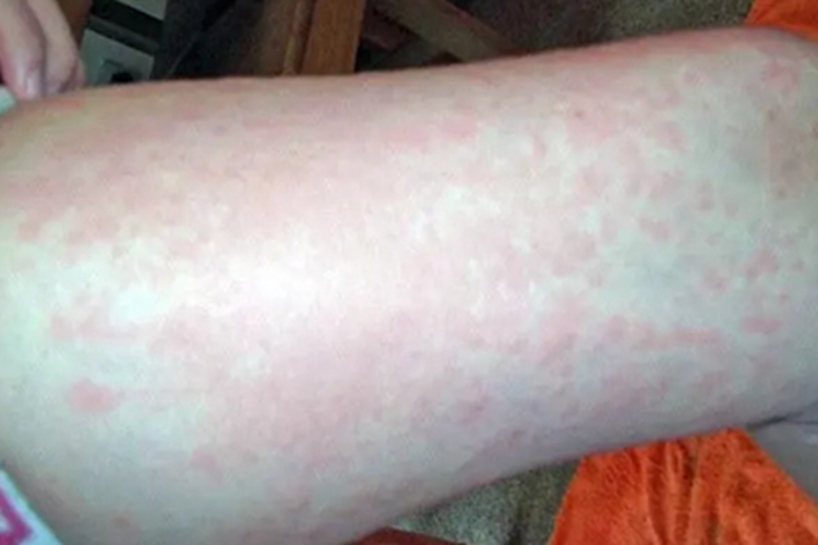 海鲜过敏大腿密集红斑图 海鲜过敏大腿密集红斑图