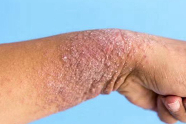 慢性湿疹手腕皮肤粗糙图