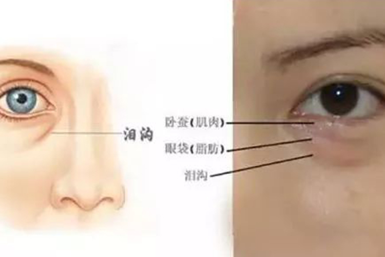 眼睛下面有一条泪沟线图