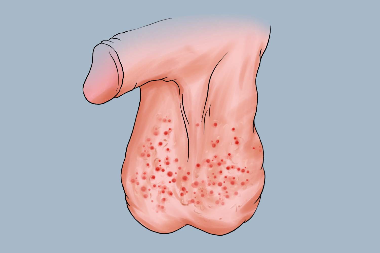 虱病阴囊手绘图