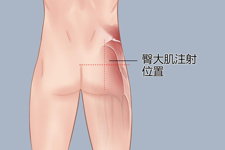 臀大肌十字法定位注射位置图
