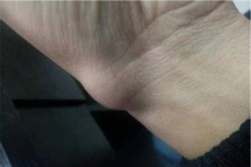 尺侧腕伸肌腱鞘炎图