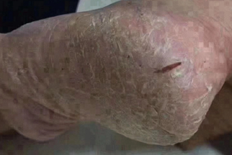 足部皲裂脚底脱屑图