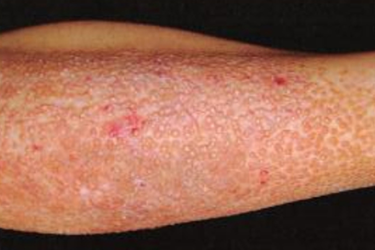 苔藓状淀粉样变图