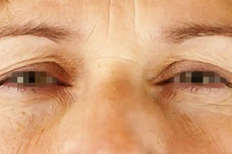 光老化眼周有明显皱纹图