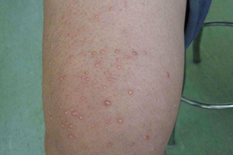 发疹性黄瘤大腿丘疹图