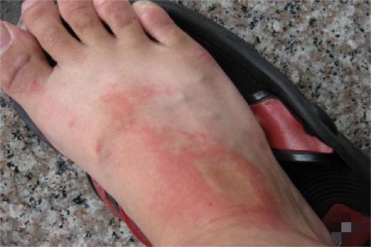 过敏性皮炎脚背症状图