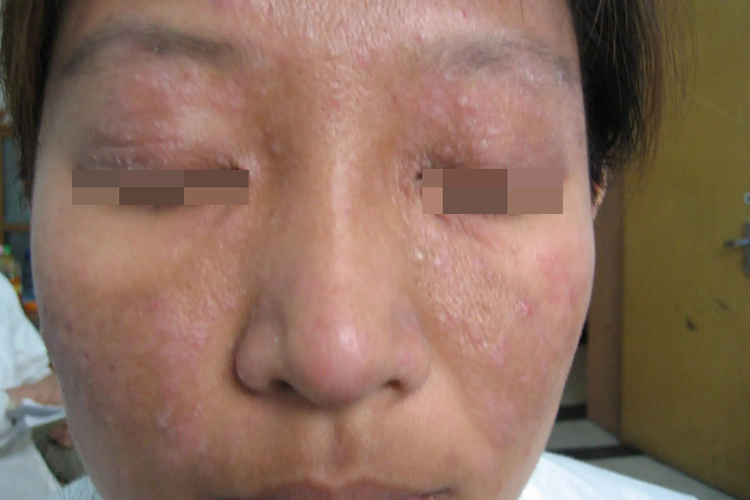 脸部多形性日光疹图 脸部多形性日光疹图