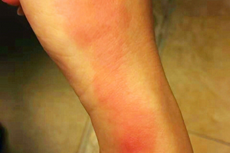 轻度扭伤手腕红肿图 轻度扭伤手腕红肿图