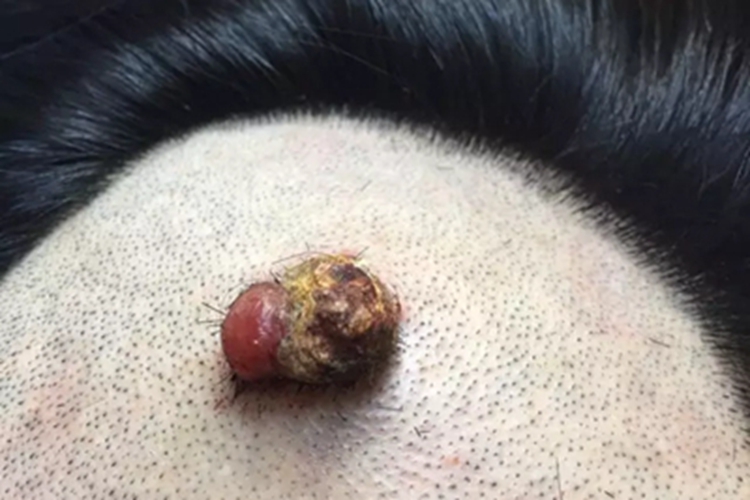 化脓性肉芽肿结痂图 化脓性肉芽肿结痂图