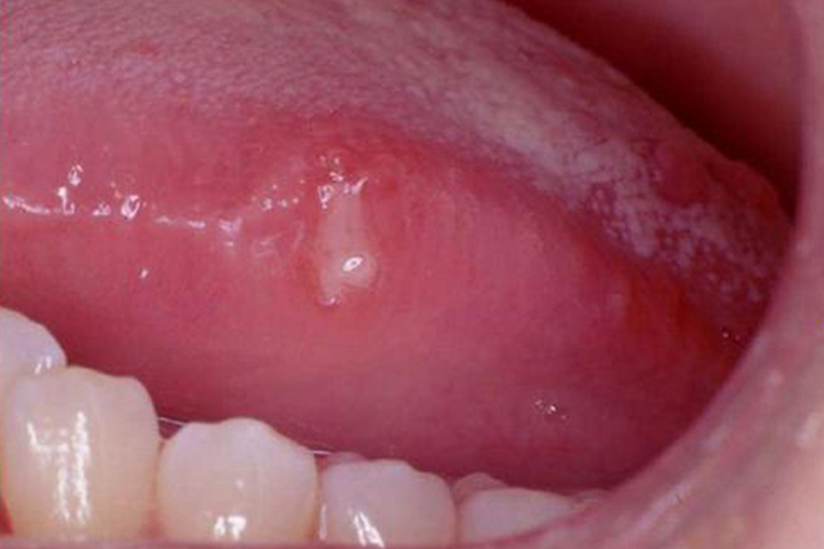 轻型阿弗他溃疡图 轻型阿弗他溃疡图