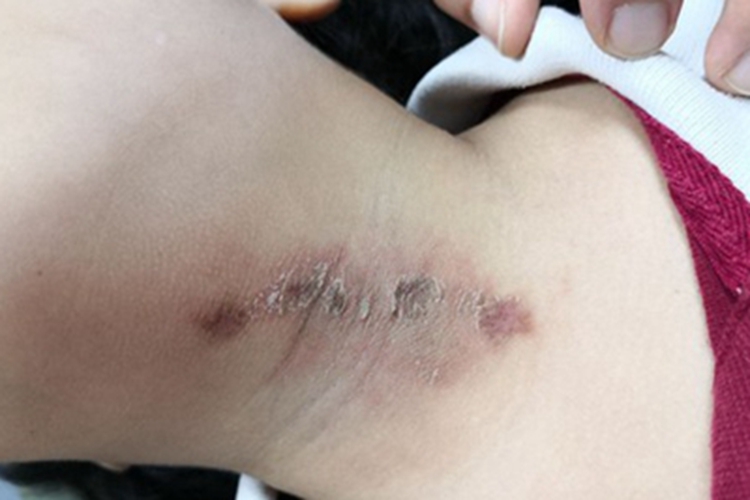 隐翅虫皮炎前颈结痂图