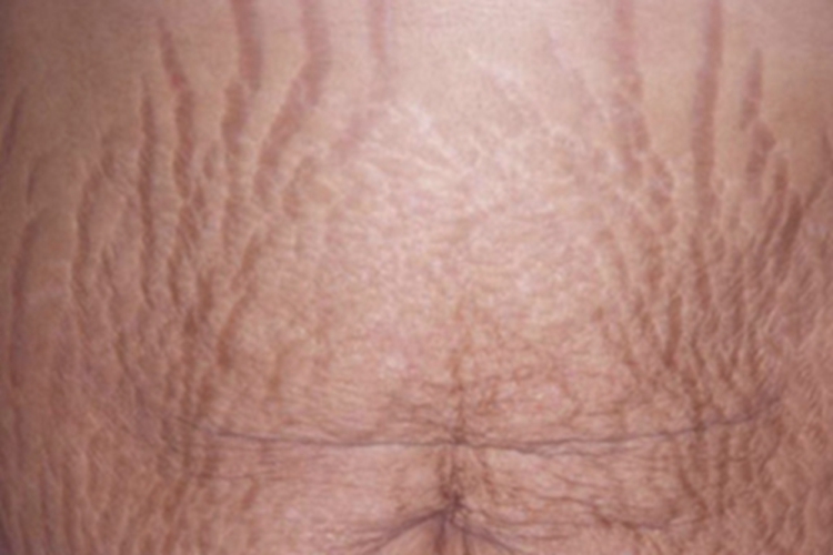 妊娠纹腹部上面有波浪花纹图