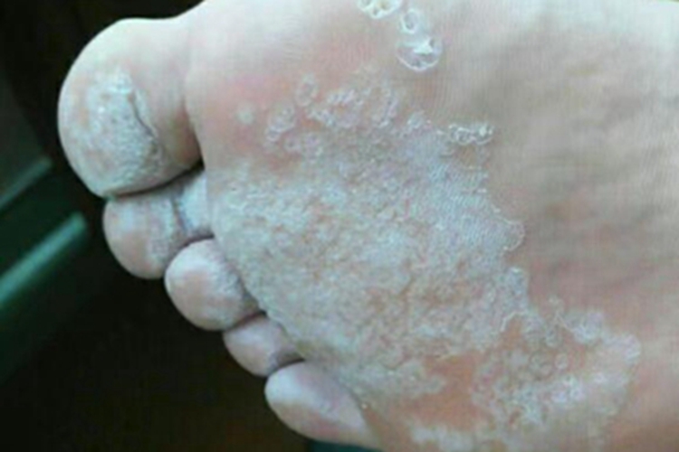 寻常疣脚底有大面积白屑图