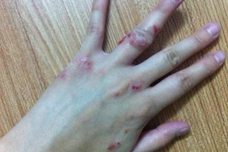 急性湿疹手部结痂图