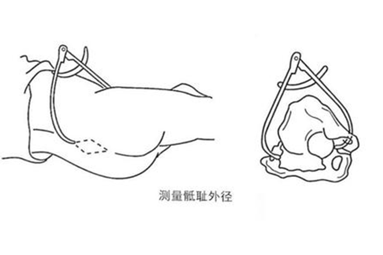 骶耻外径测量图