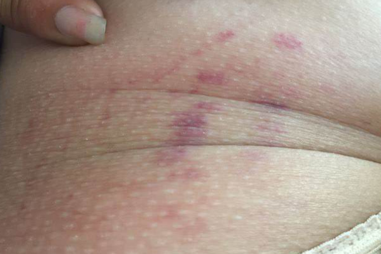 大腿窝两侧过敏性紫癜图