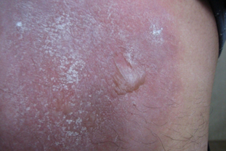 接触性皮炎背部水疱图