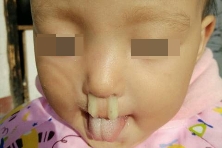 鼻炎脓性鼻涕图