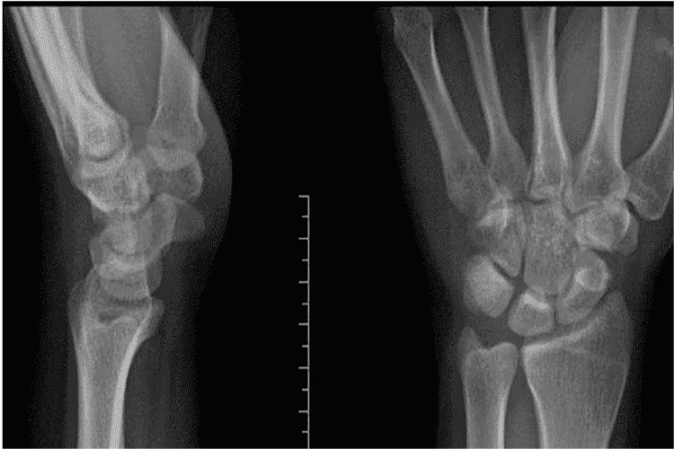 腕关节X线图