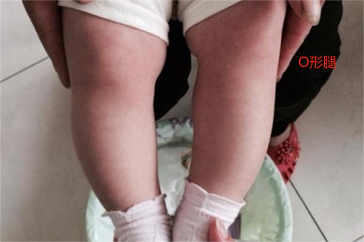 佝偻病O形腿图图