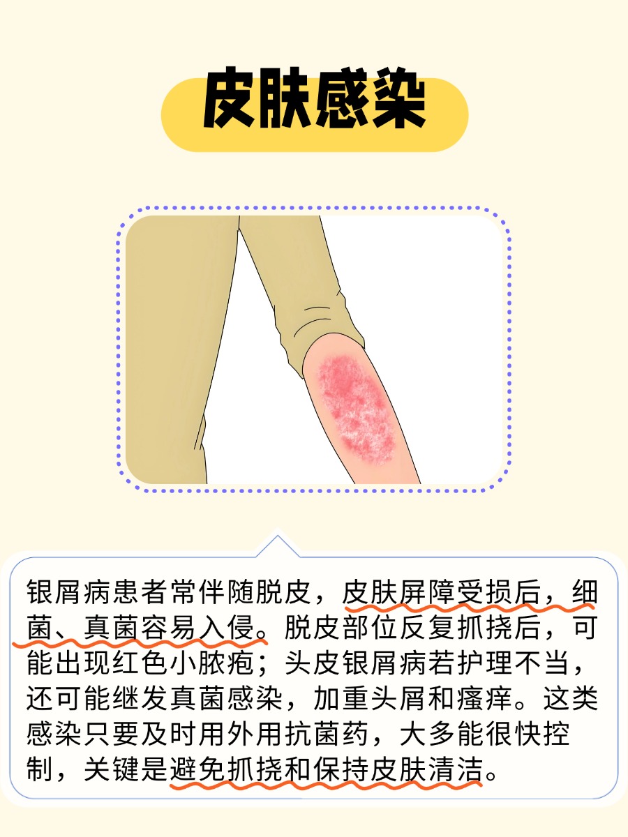 银屑病会引起哪些疾病？医生：不控制后果重
