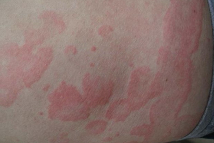 远心性环状红斑腰部有大片红斑图 远心性环状红斑腰部有大片红斑图