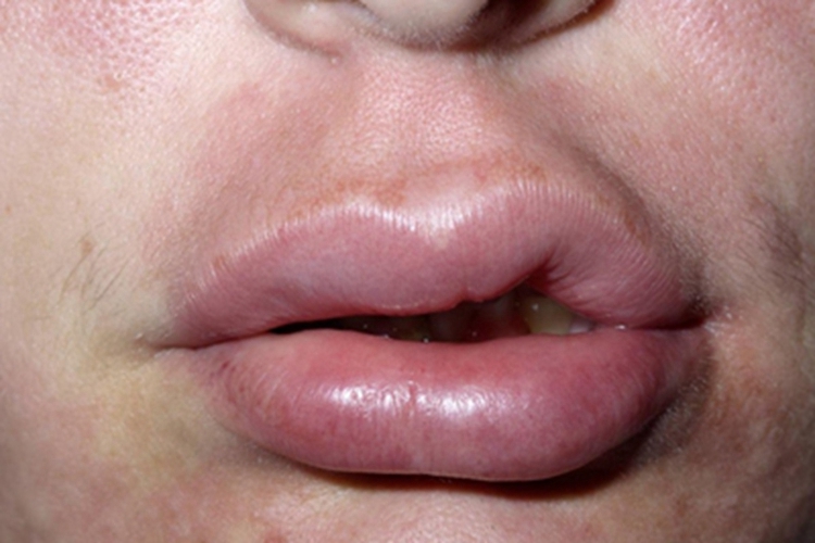 血管性水肿嘴唇肿图<br />
##@@需裁剪 血管性水肿嘴唇肿图<br />
##@@需裁剪