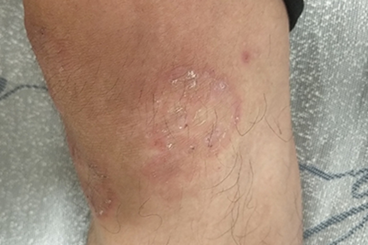 亚急性湿疹膝盖症状图