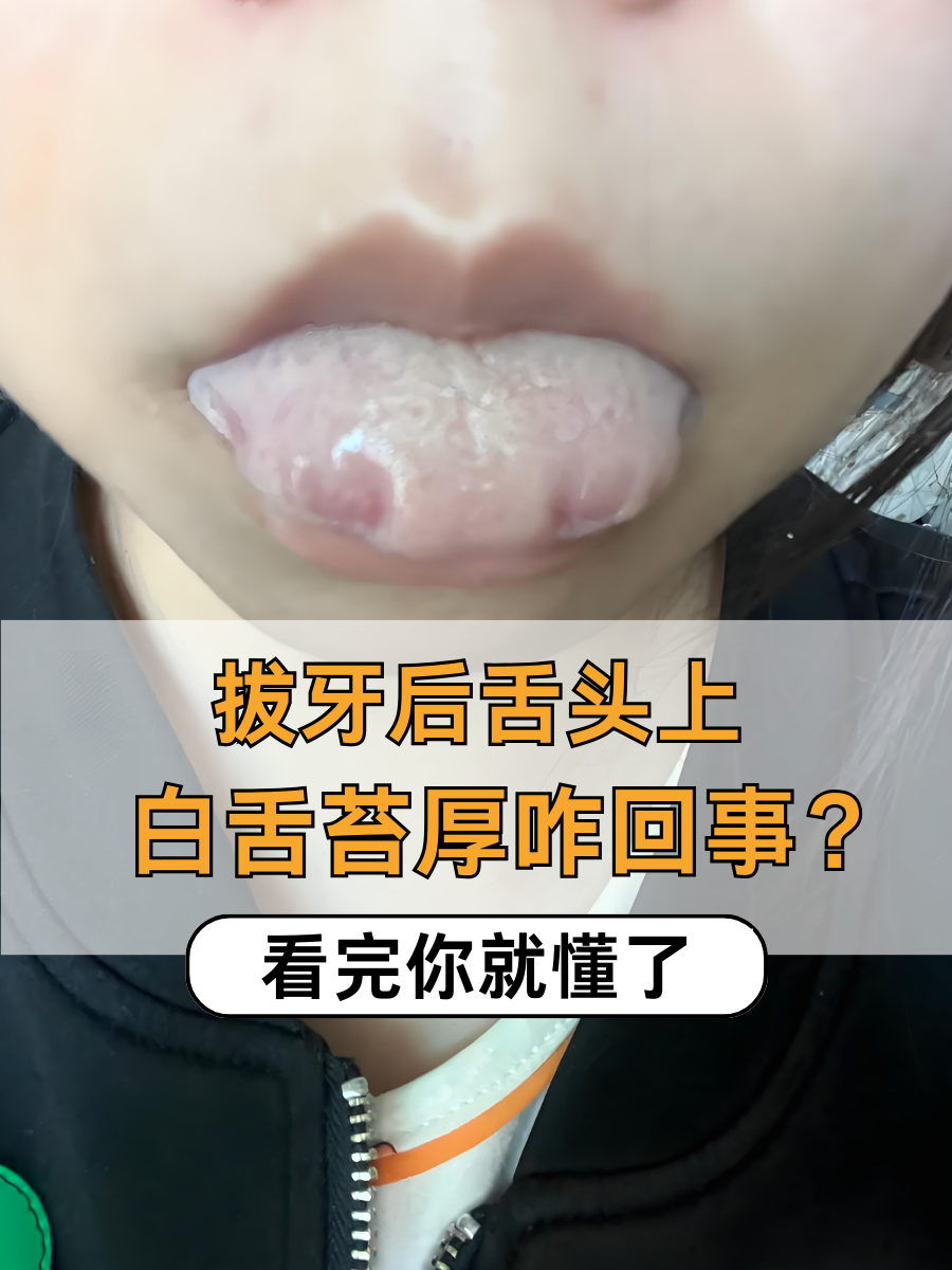 拔牙后舌头上白舌苔厚咋回事？看完你就懂了