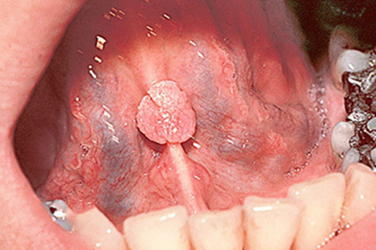 口腔尖锐湿疣肉球图 口腔尖锐湿疣肉球图